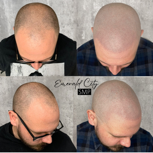 before and after smp treatment